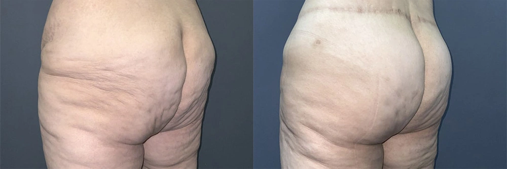 Real Patient Results in Newport Beach, CA. Preformed by Semira Bayait, MD, FACS.