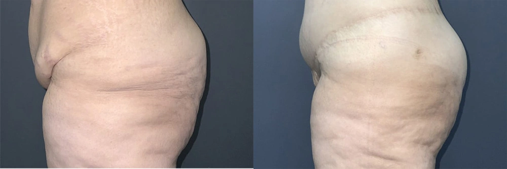 Real Patient Results in Newport Beach, CA. Preformed by Semira Bayait, MD, FACS.