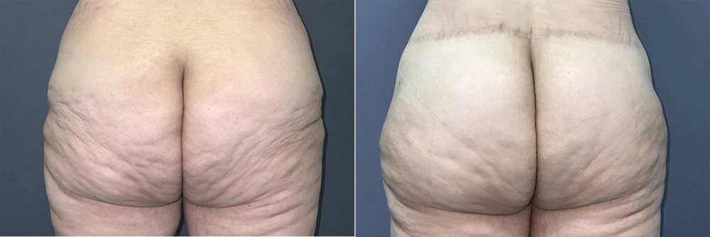 Real Patient Results in Newport Beach, CA. Preformed by Semira Bayait, MD, FACS.