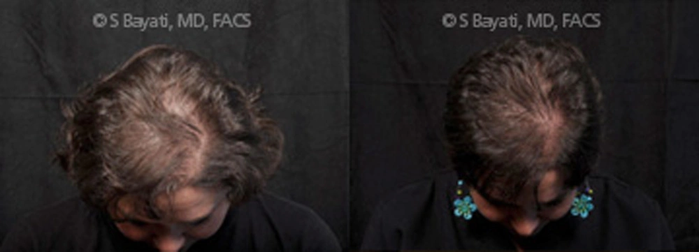 Real Patient Results in Newport Beach, CA. Preformed by Semira Bayait, MD, FACS.