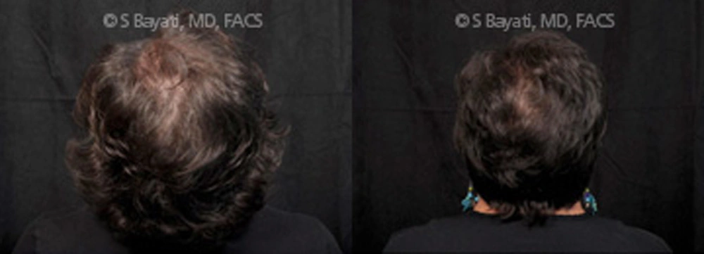 Real Patient Results in Newport Beach, CA. Preformed by Semira Bayait, MD, FACS.