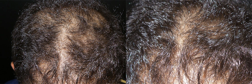 Real Patient Results in Newport Beach, CA. Preformed by Semira Bayait, MD, FACS.