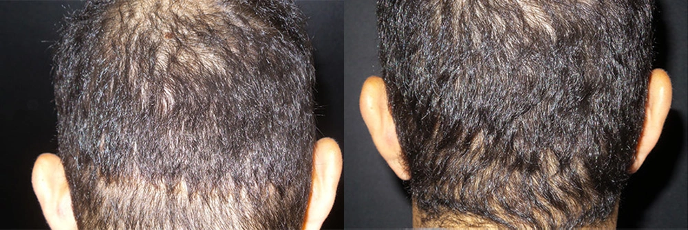 Real Patient Results in Newport Beach, CA. Preformed by Semira Bayait, MD, FACS.