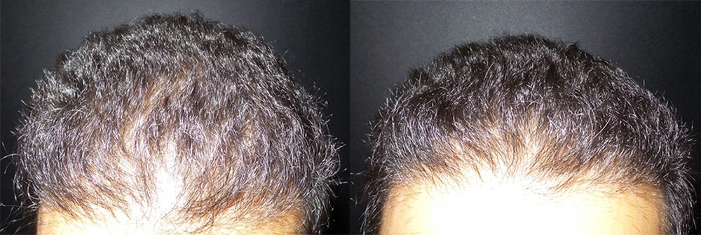 Real Patient Results in Newport Beach, CA. Preformed by Semira Bayait, MD, FACS.