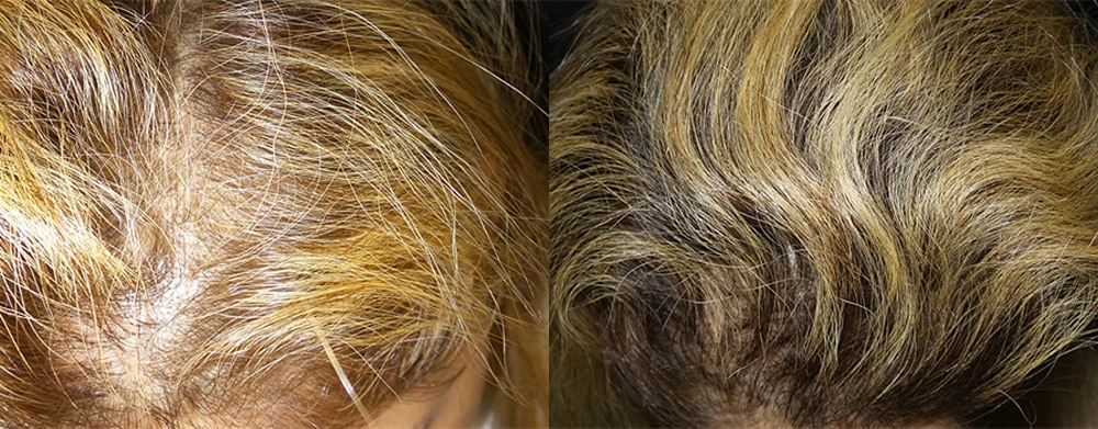 Real Patient Results in Newport Beach, CA. Preformed by Semira Bayait, MD, FACS.