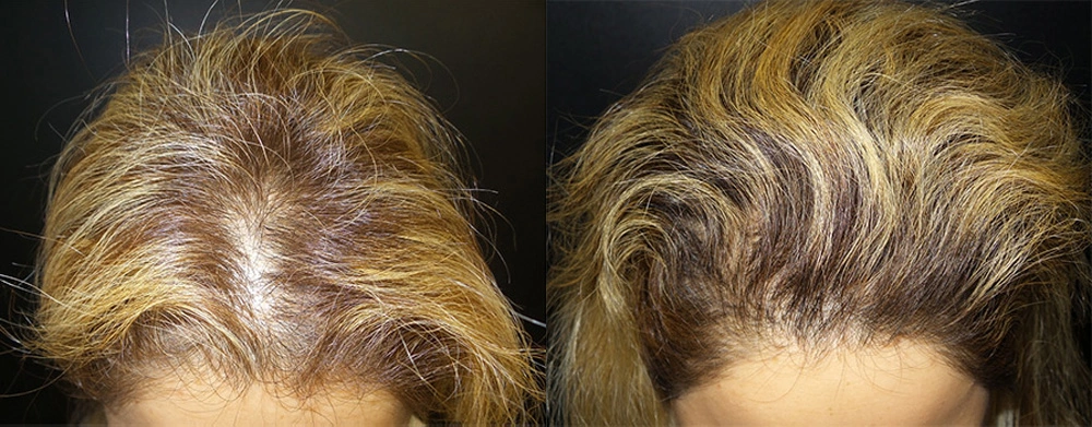Real Patient Results in Newport Beach, CA. Preformed by Semira Bayait, MD, FACS.