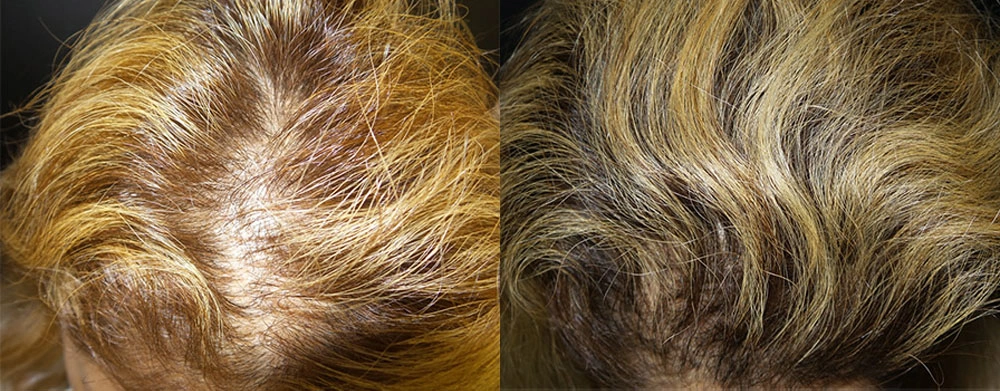 Real Patient Results in Newport Beach, CA. Preformed by Semira Bayait, MD, FACS.