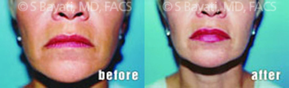 Real Patient Results in Newport Beach, CA. Preformed by Semira Bayait, MD, FACS.