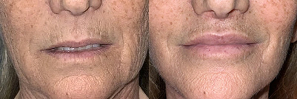 Real Patient Results in Newport Beach, CA. Preformed by Semira Bayait, MD, FACS.
