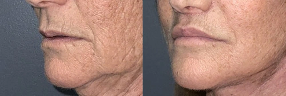 Real Patient Results in Newport Beach, CA. Preformed by Semira Bayait, MD, FACS.