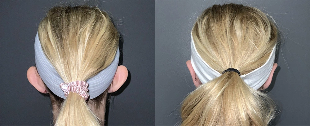 Real Patient Results in Newport Beach, CA. Preformed by Semira Bayait, MD, FACS.
