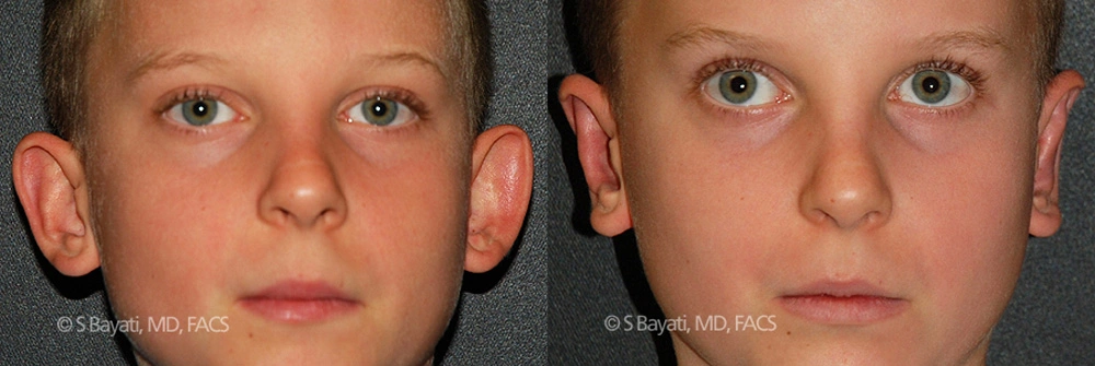 Real Patient Results in Newport Beach, CA. Preformed by Semira Bayait, MD, FACS.