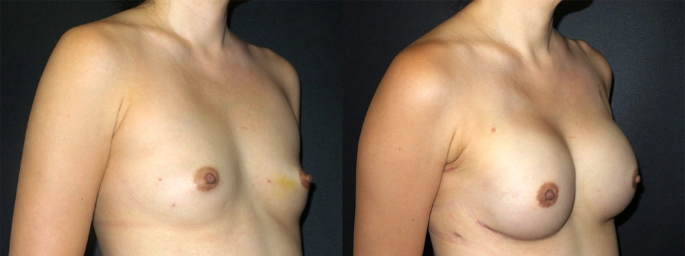 Real Patient Results in Newport Beach, CA. Preformed by Semira Bayait, MD, FACS.