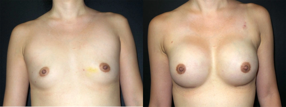 Real Patient Results in Newport Beach, CA. Preformed by Semira Bayait, MD, FACS.