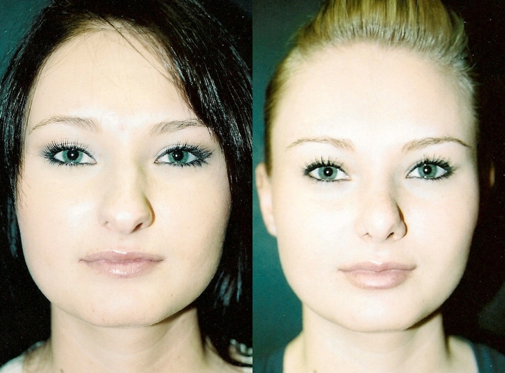 Real Patient Results in Newport Beach, CA. Preformed by Semira Bayait, MD, FACS.