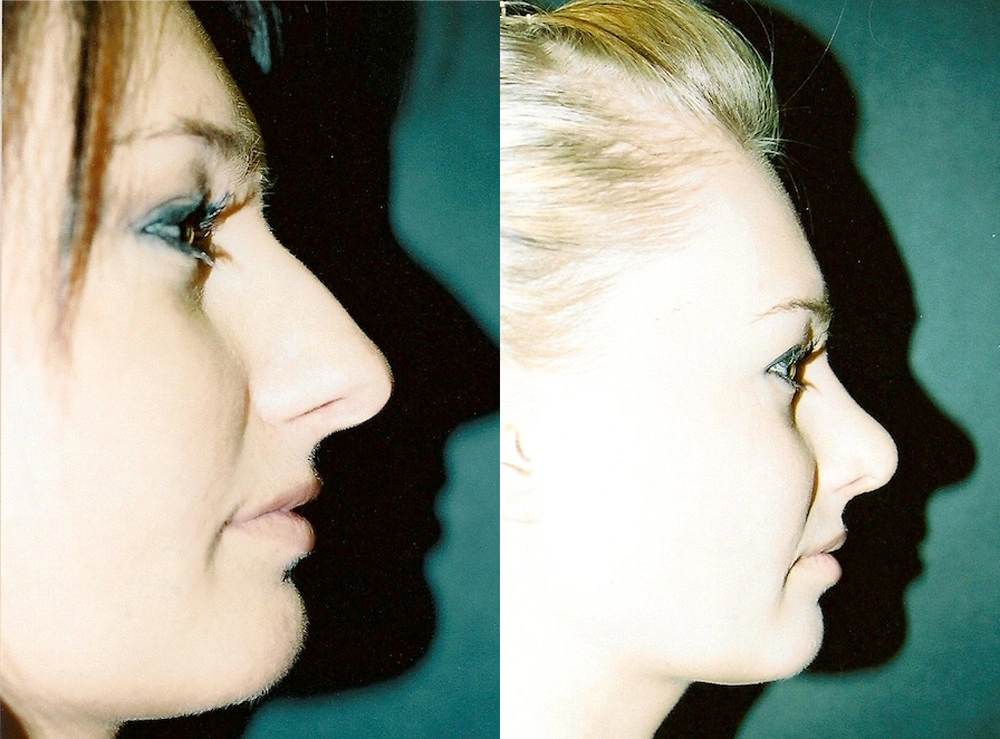Real Patient Results in Newport Beach, CA. Preformed by Semira Bayait, MD, FACS.
