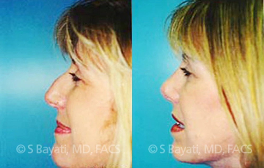 Real Patient Results in Newport Beach, CA. Preformed by Semira Bayait, MD, FACS.