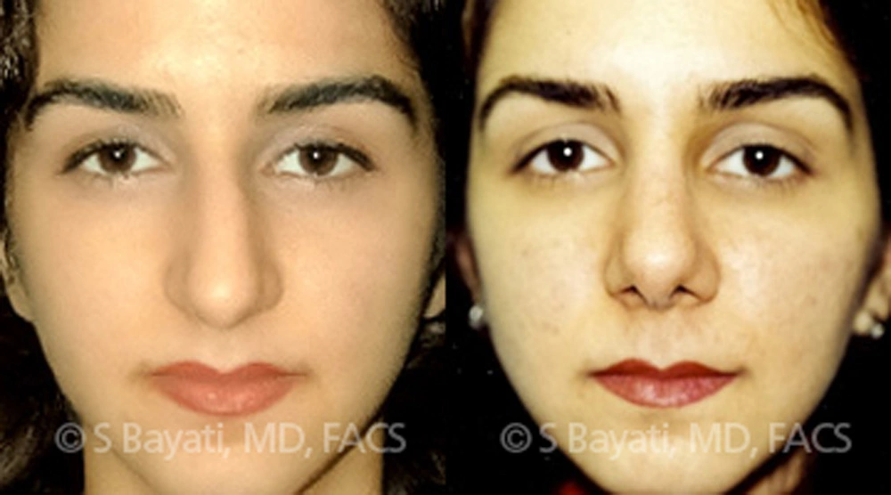 Real Patient Results in Newport Beach, CA. Preformed by Semira Bayait, MD, FACS.