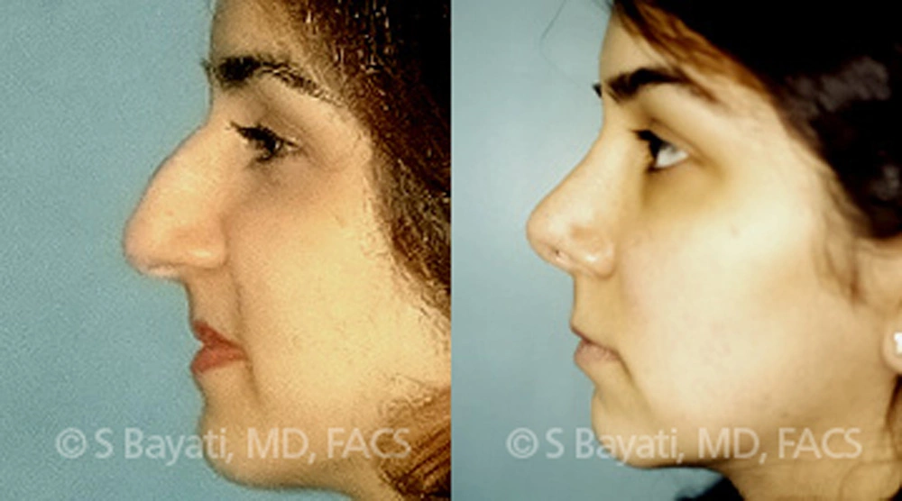 Real Patient Results in Newport Beach, CA. Preformed by Semira Bayait, MD, FACS.