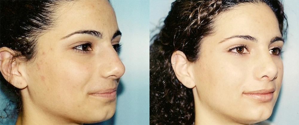 Real Patient Results in Newport Beach, CA. Preformed by Semira Bayait, MD, FACS.
