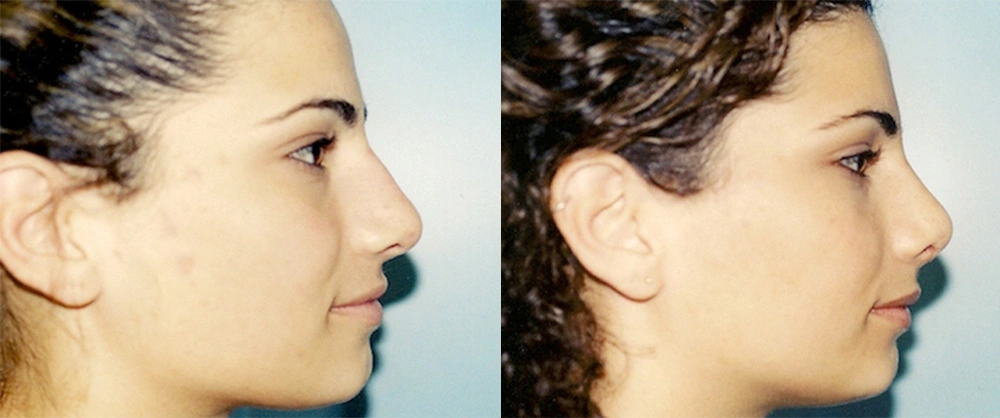 Real Patient Results in Newport Beach, CA. Preformed by Semira Bayait, MD, FACS.