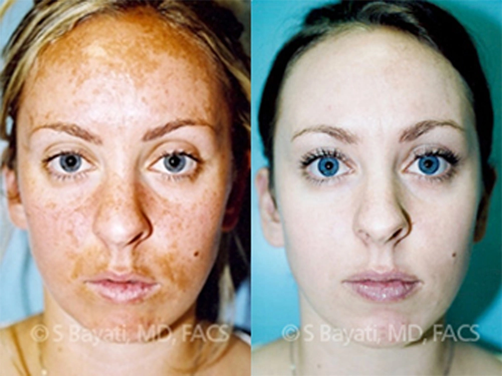 Real Patient Results in Newport Beach, CA. Preformed by Semira Bayait, MD, FACS.