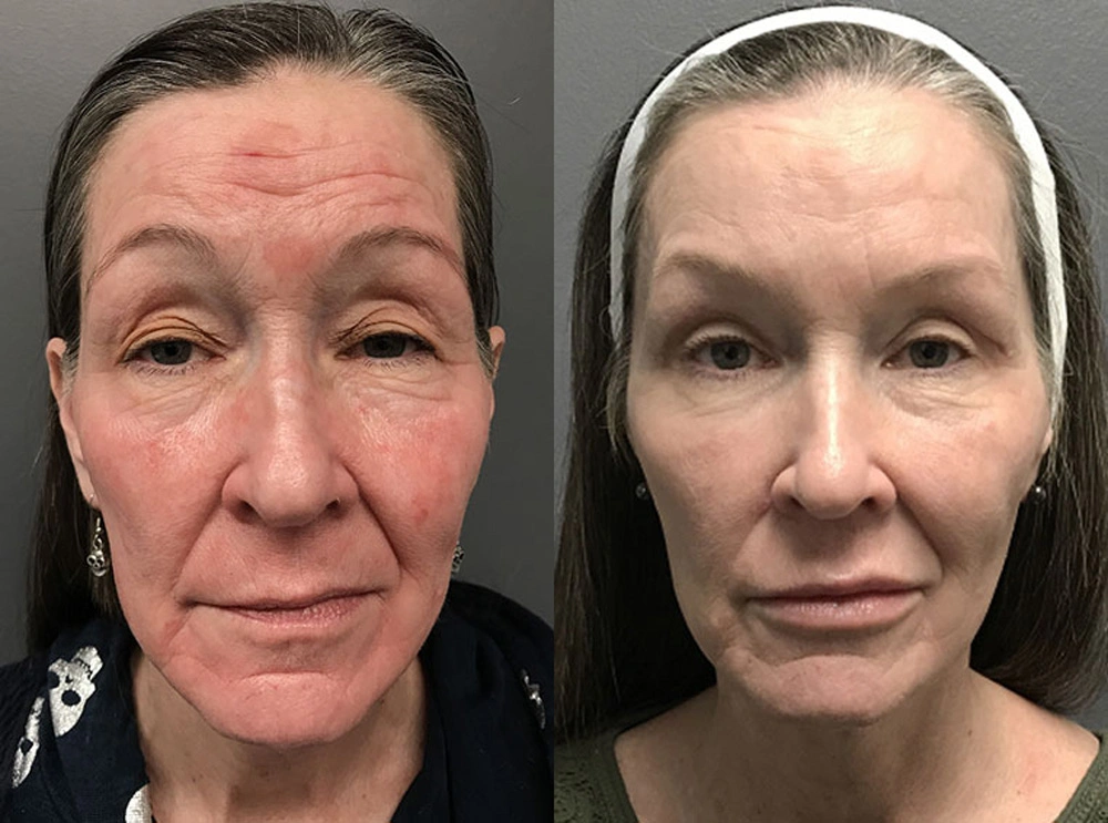 Real Patient Results in Newport Beach, CA. Preformed by Semira Bayait, MD, FACS.